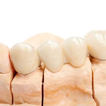 Dental Bridges in Marina del Rey