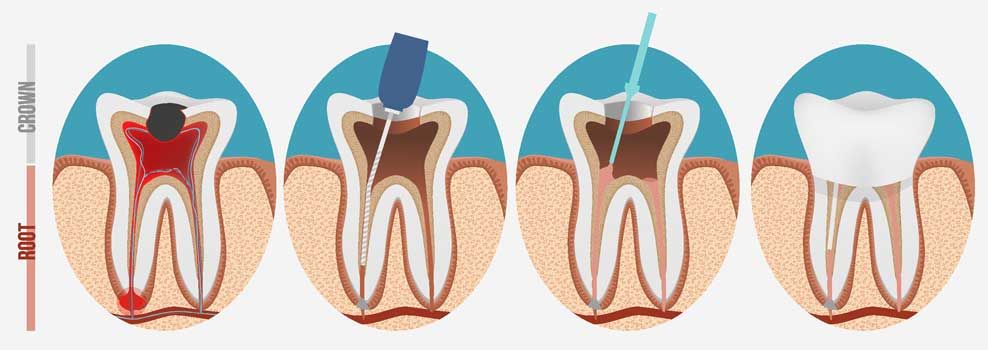 ROOT CANAL TREATMENT