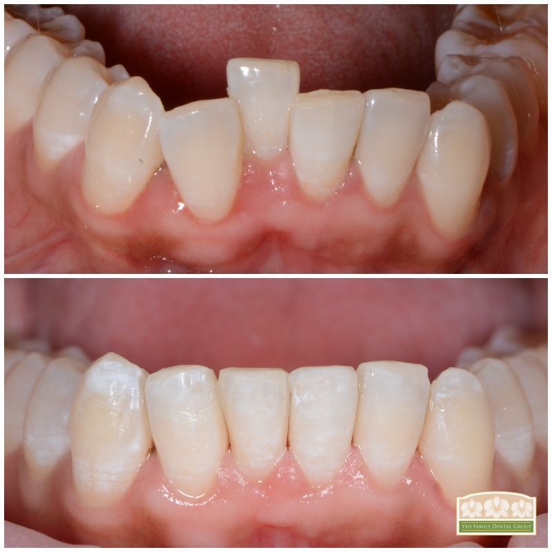 Orthodontic Treatment Before & After