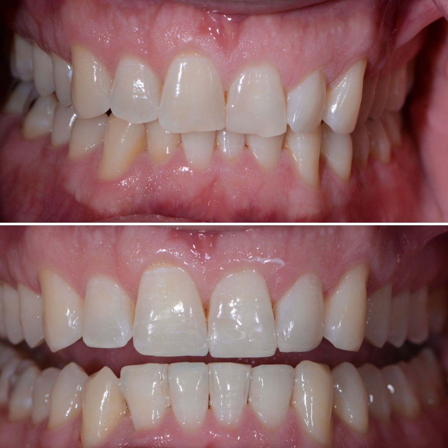 Orthodontic Treatment Before & After