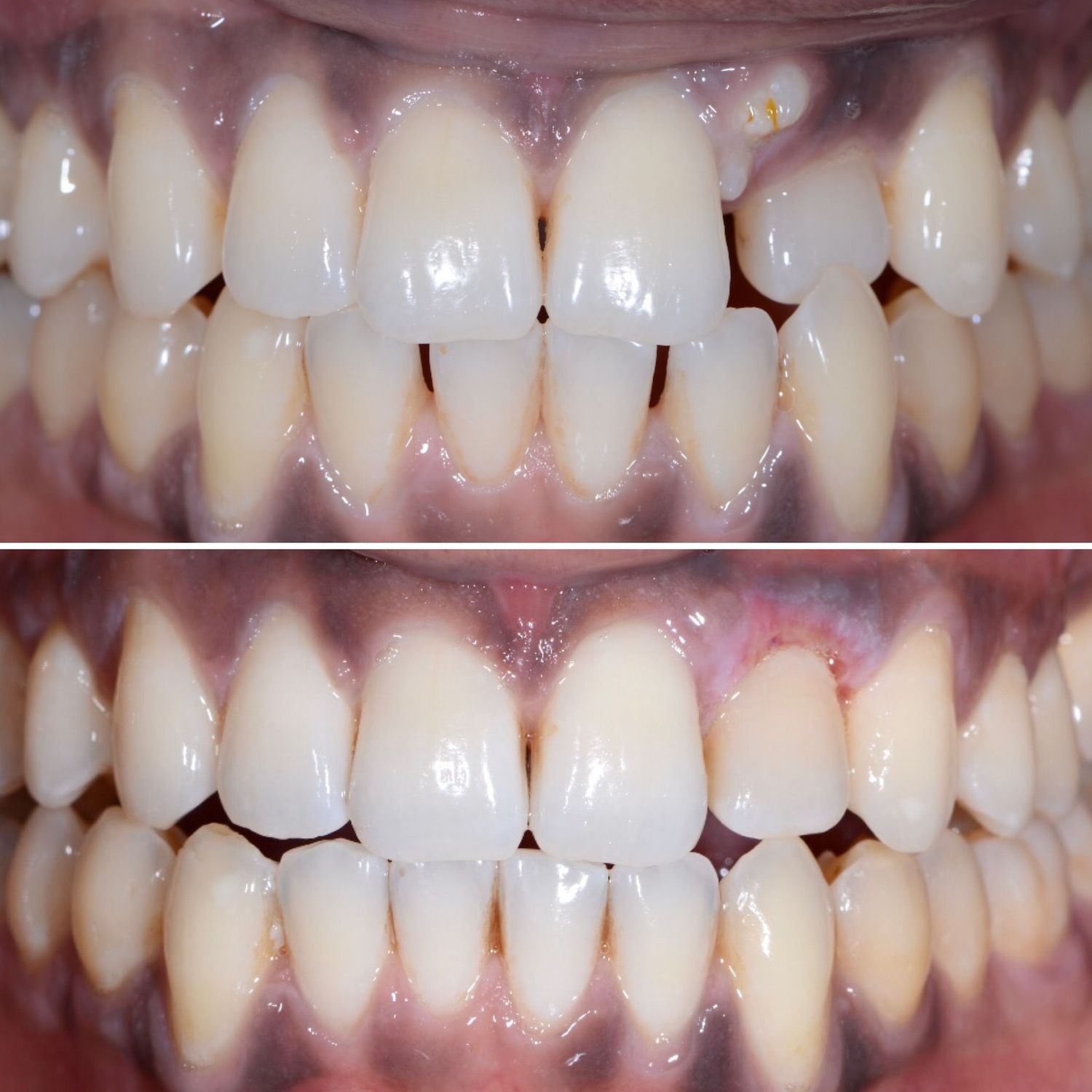 Orthodontic Treatment Before & After