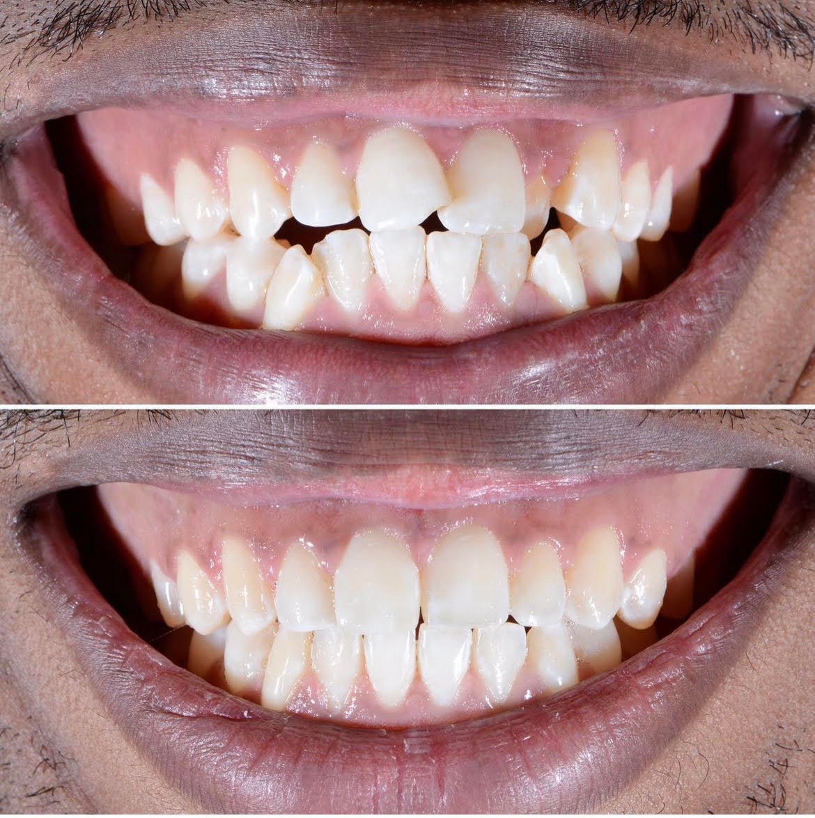 Orthodontic Treatment Before & After
