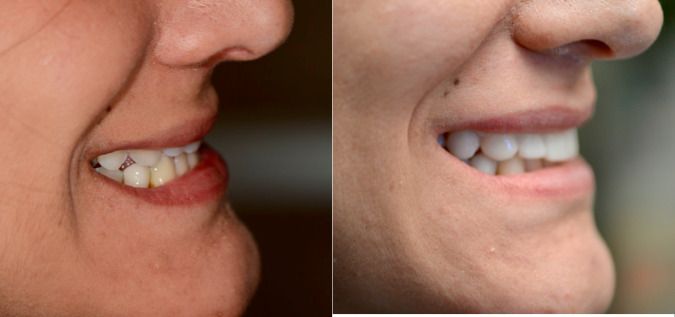 Direct Bonding Before & After