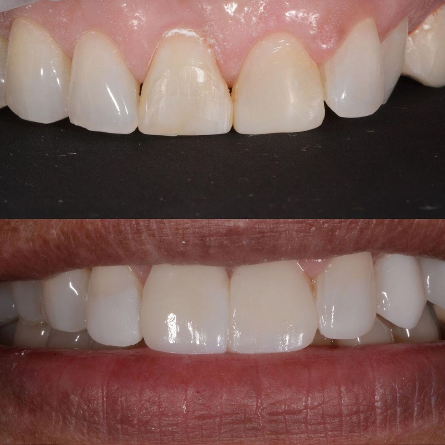 Direct Bonding Before & After