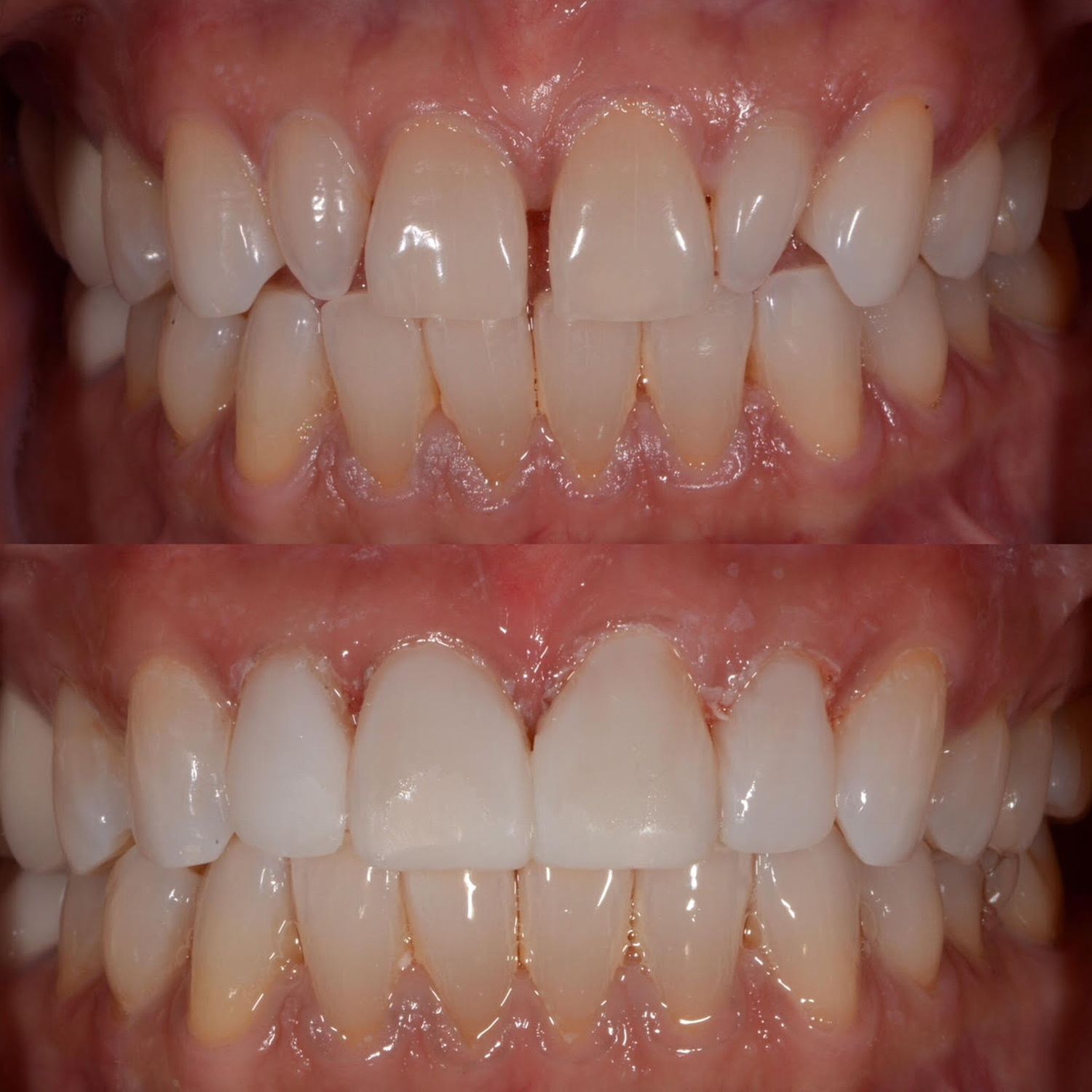 Direct Bonding Before & After