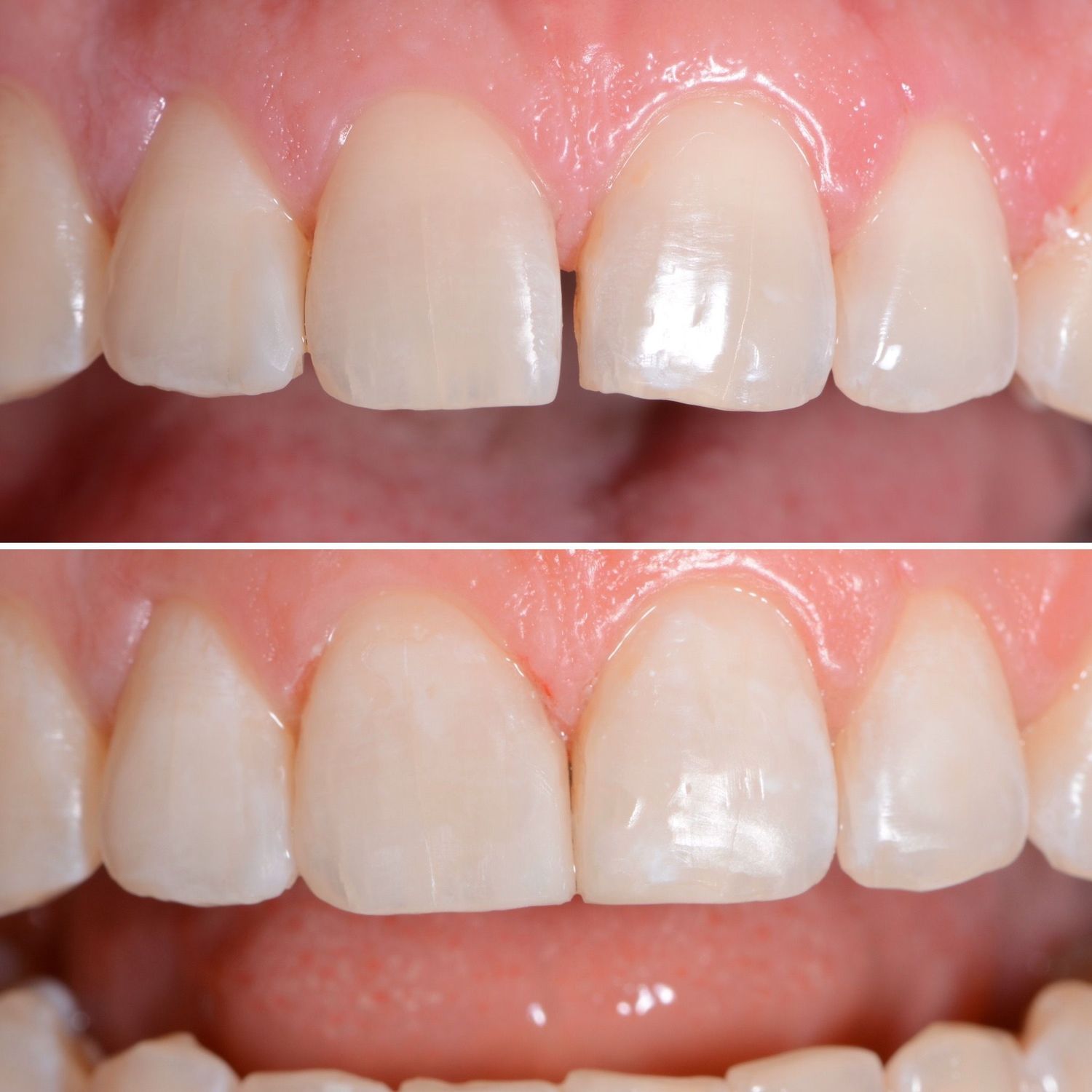 Direct Bonding Before & After