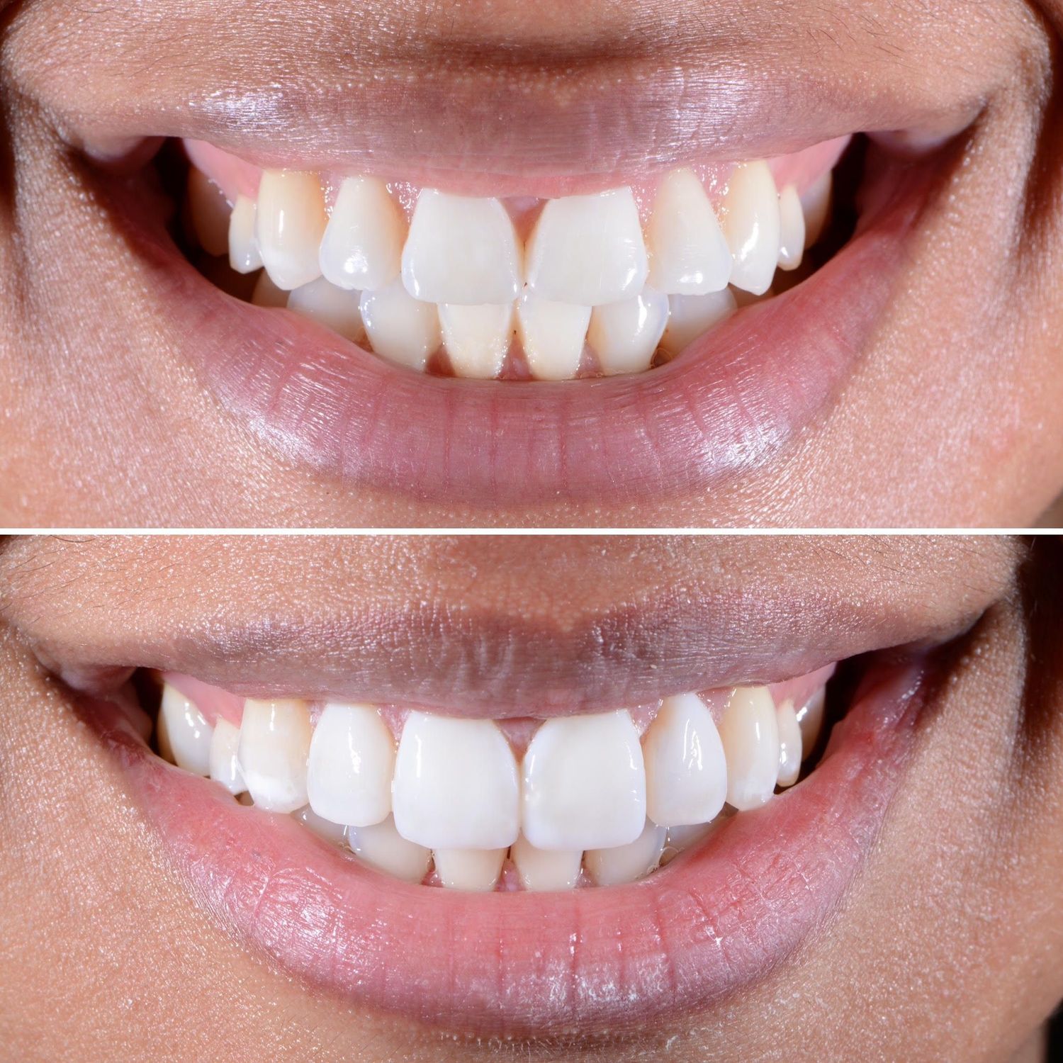 Direct Bonding Before & After