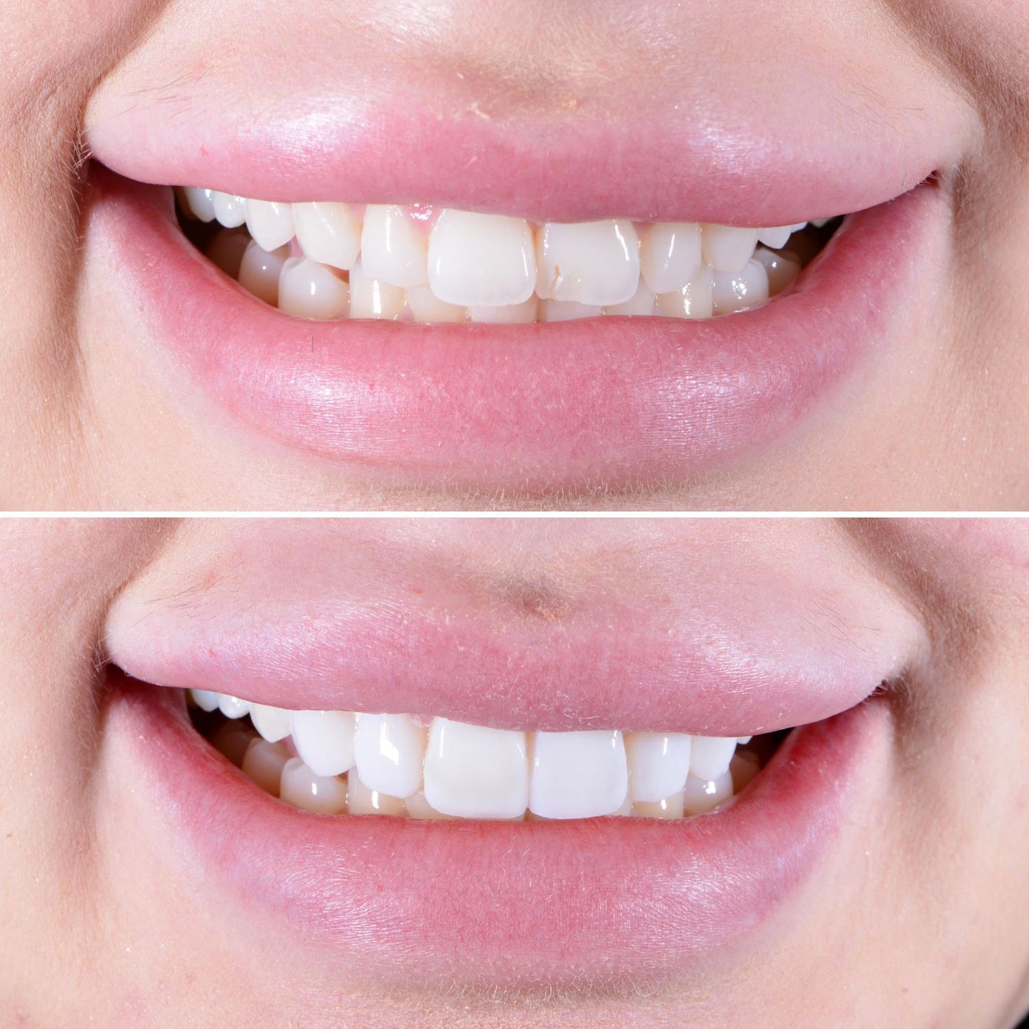 Direct Bonding Before & After