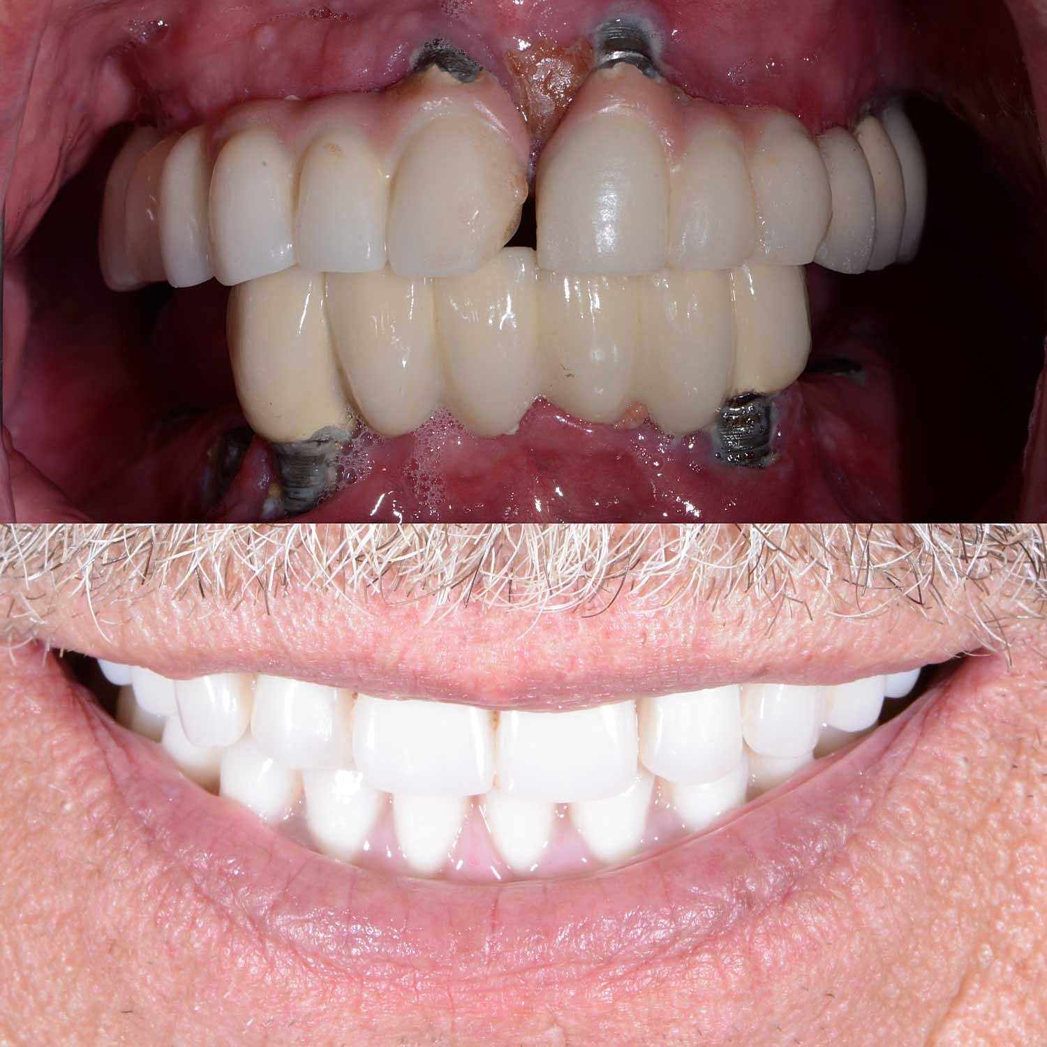 All on 4 Implant Before & After