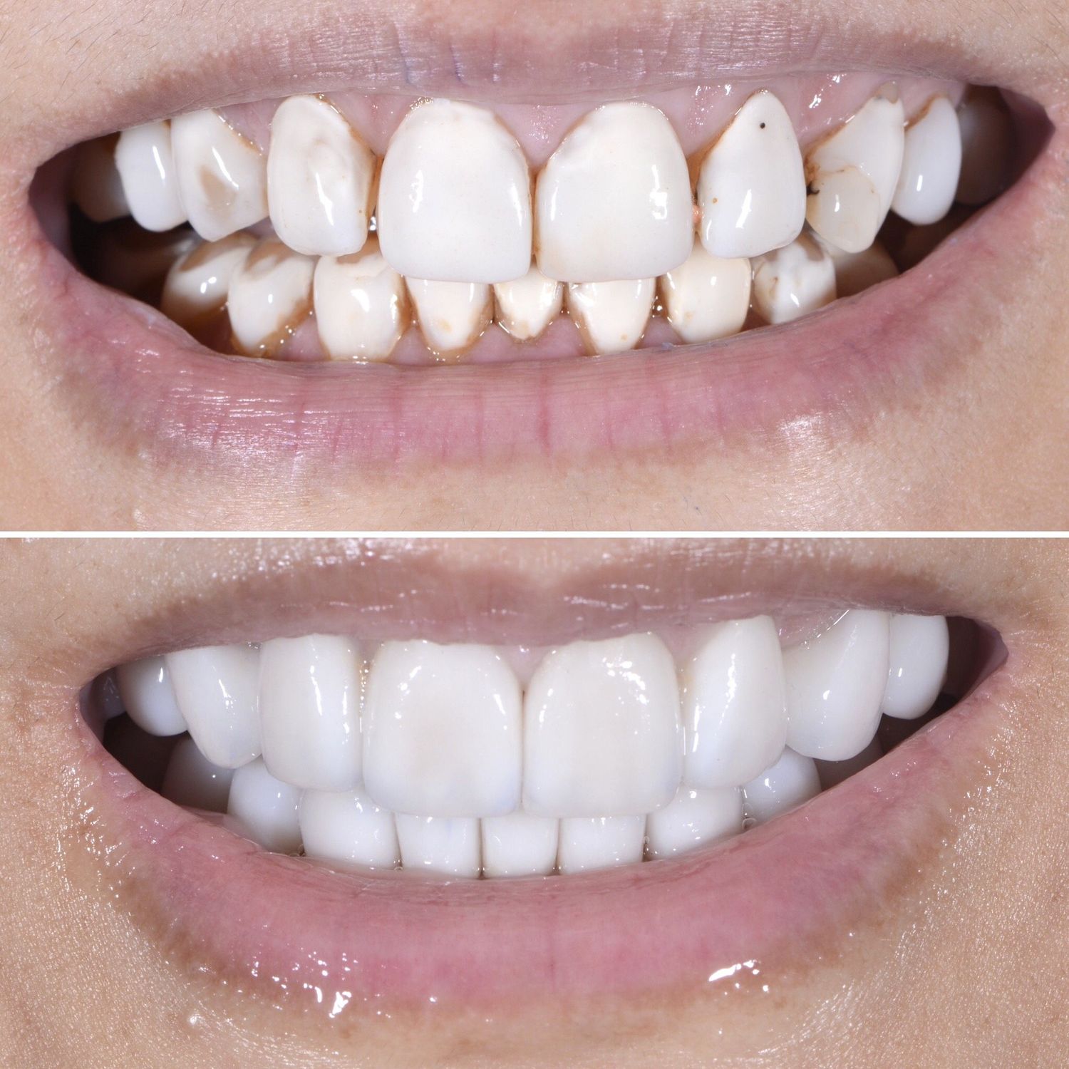 Porcelain Crown Veneers Before & After