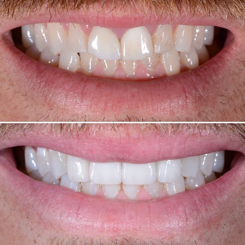 Porcelain Crown Veneers Before & After