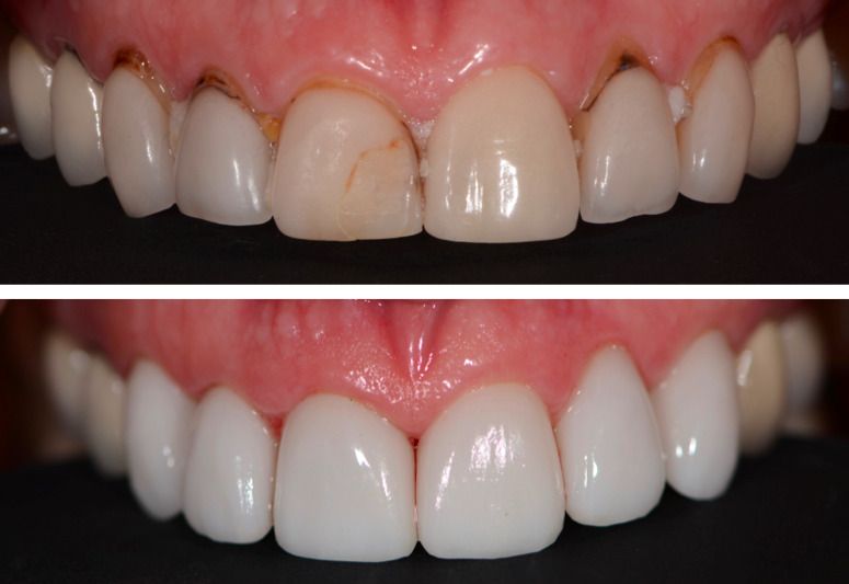 Porcelain Crown Veneers Before & After