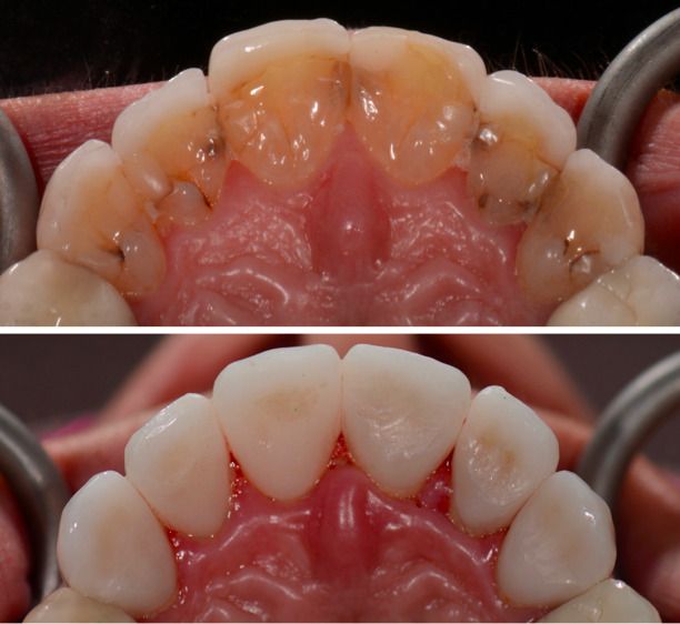 Porcelain Crown Veneers Before & After