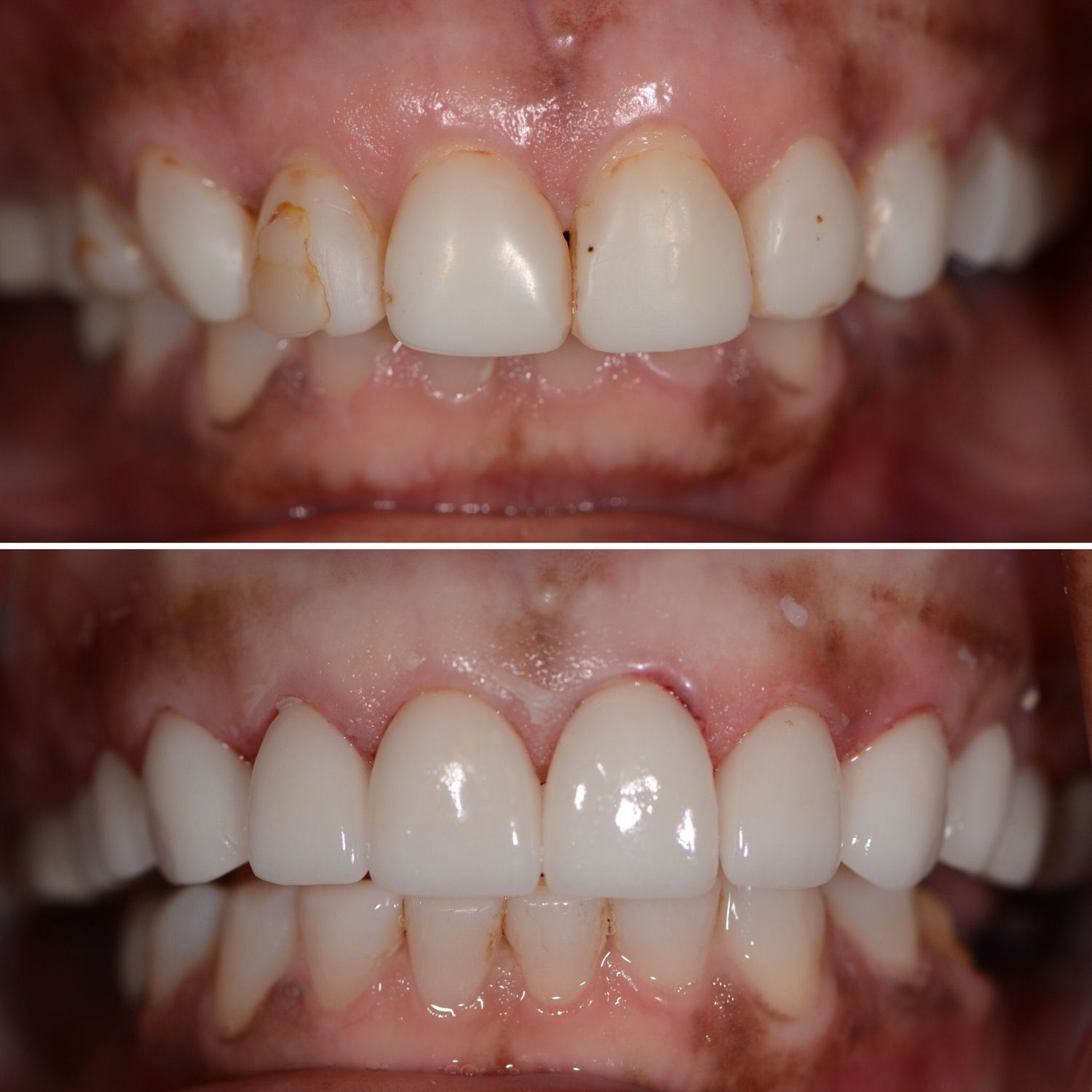 Porcelain Crown Veneers Before & After