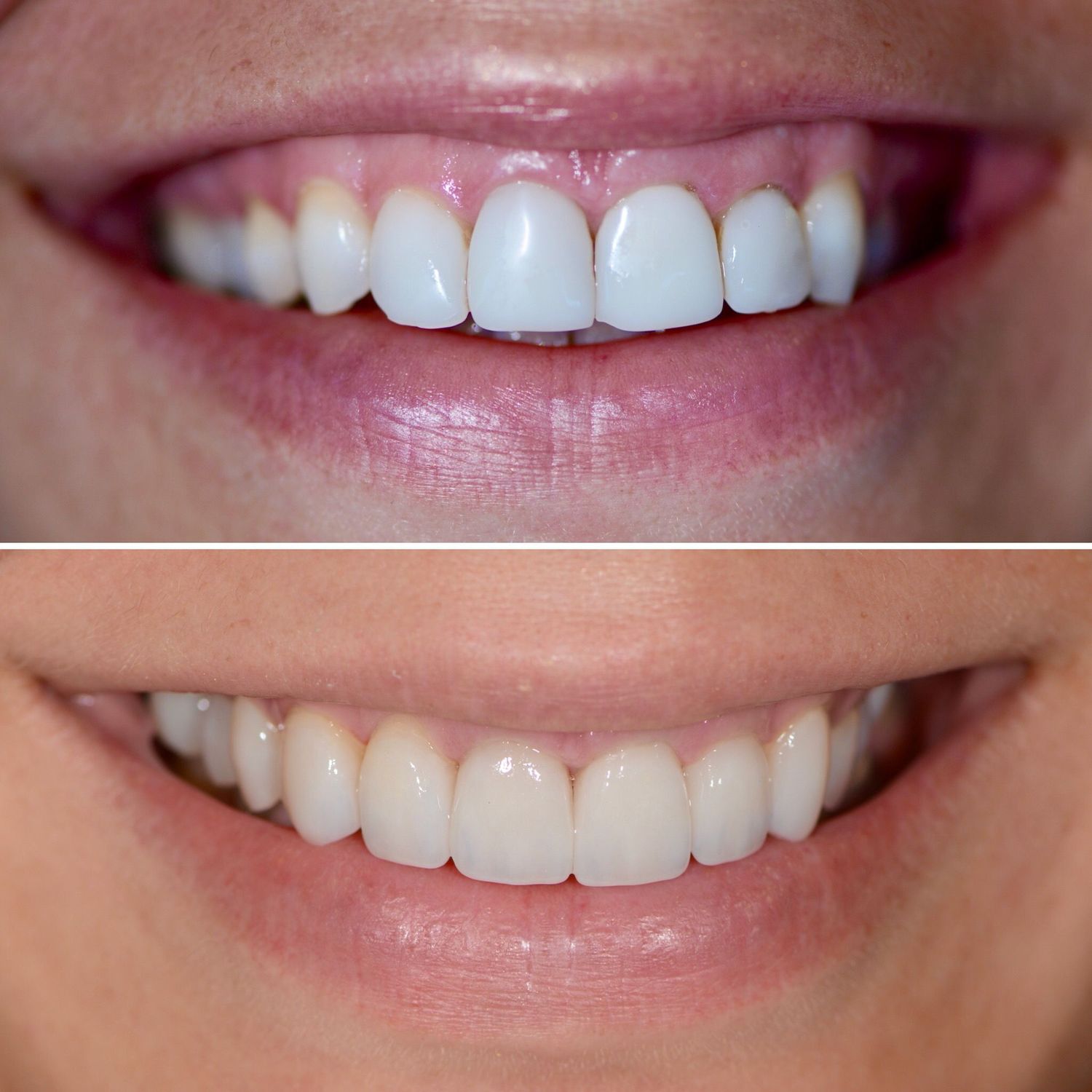 Porcelain Crown Veneers Before & After