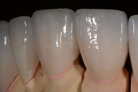 Porcelain Crown Veneers Before & After