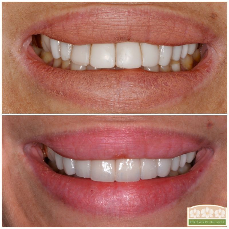 Porcelain Crown Veneers Before & After