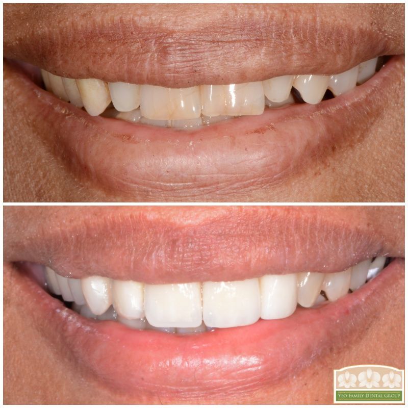 Porcelain Crown Veneers Before & After
