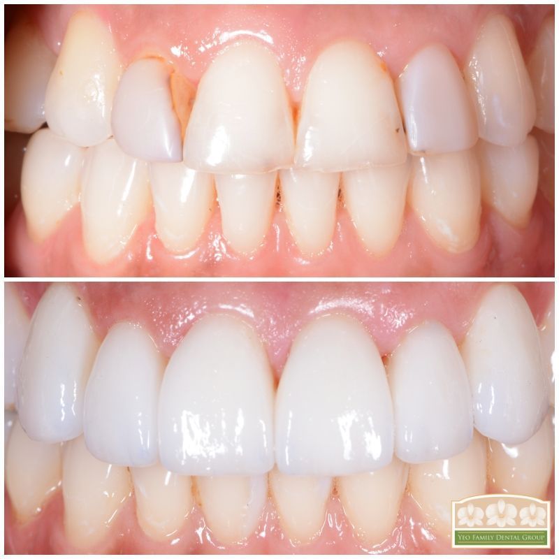 Porcelain Crown Veneers Before & After