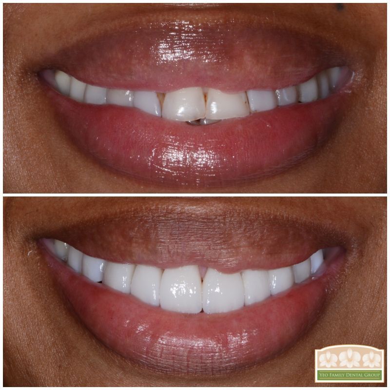 Porcelain Crown Veneers Before & After