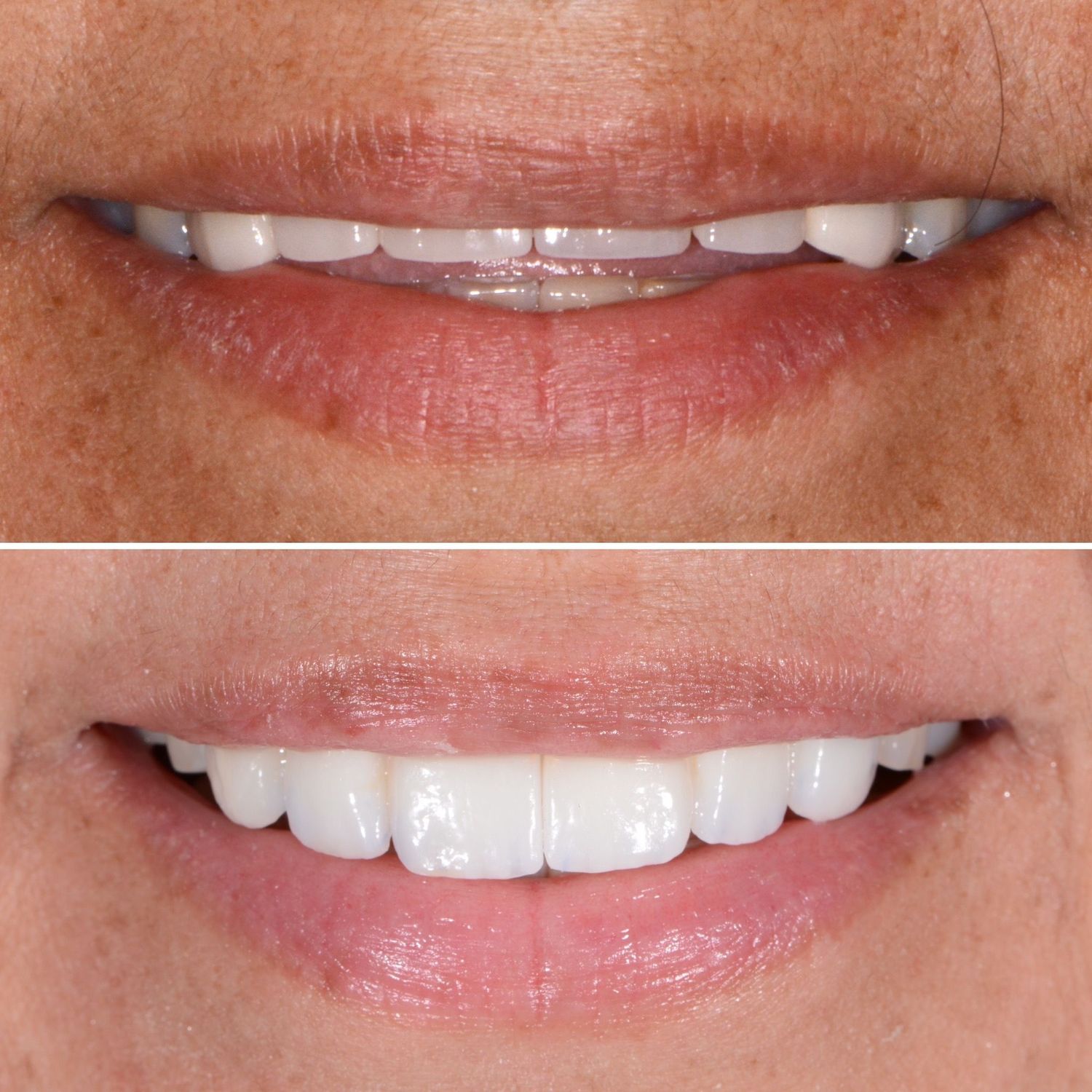 Porcelain Crown Veneers Before & After