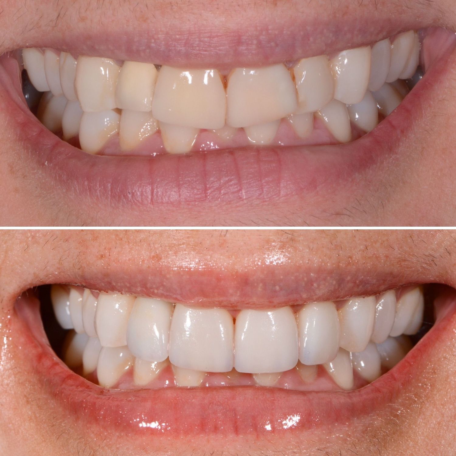 Porcelain Crown Veneers Before & After