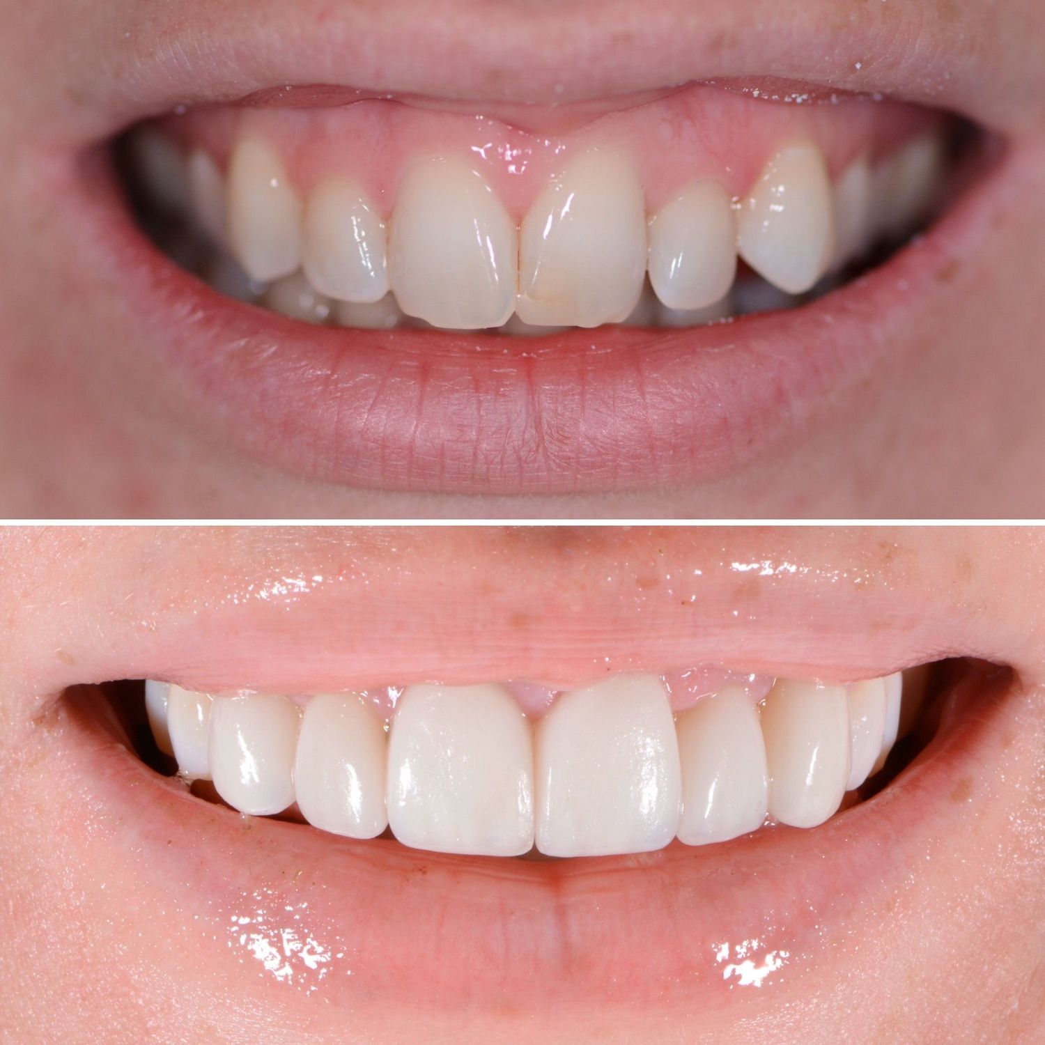 Porcelain Crown Veneers Before & After