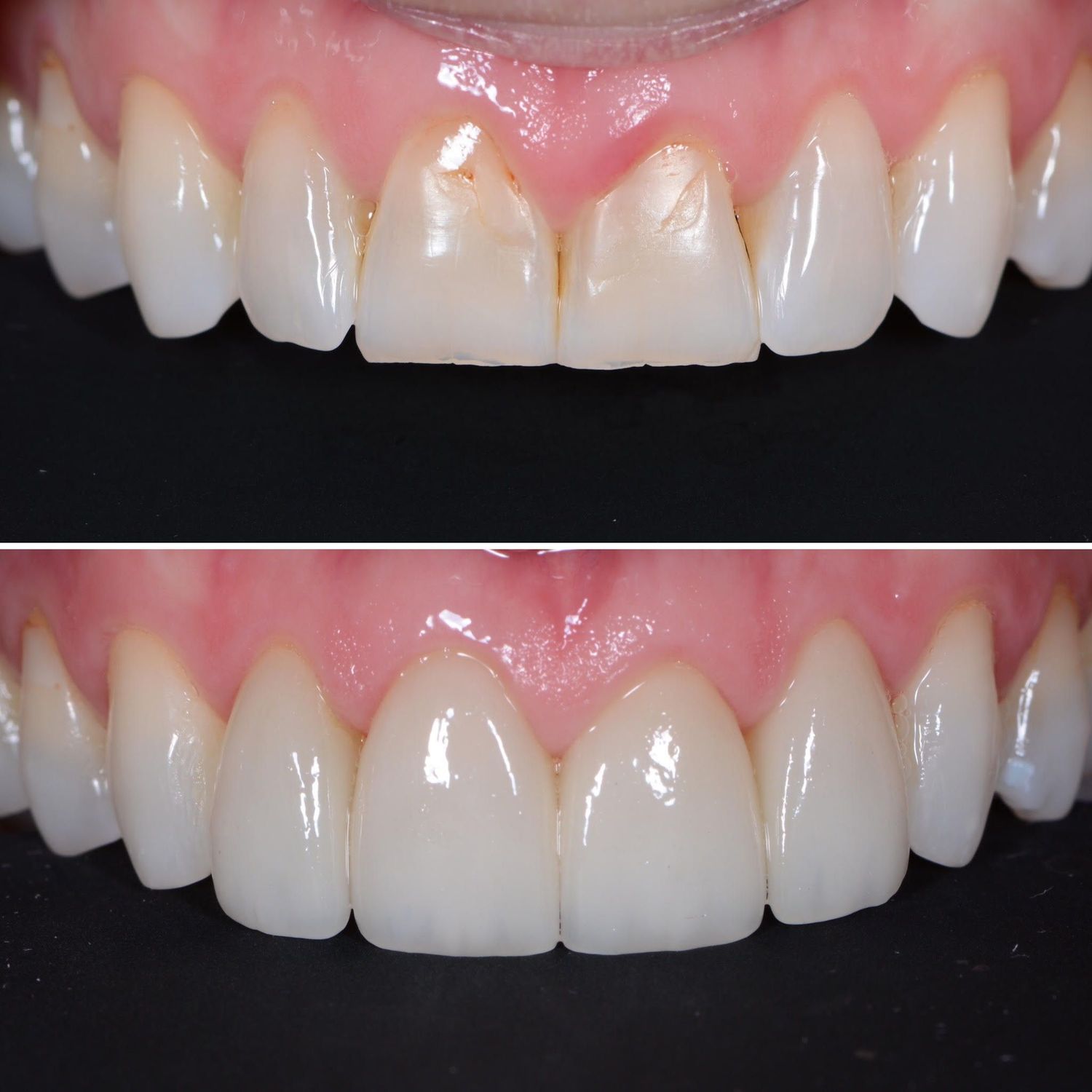 Porcelain Crown Veneers Before & After