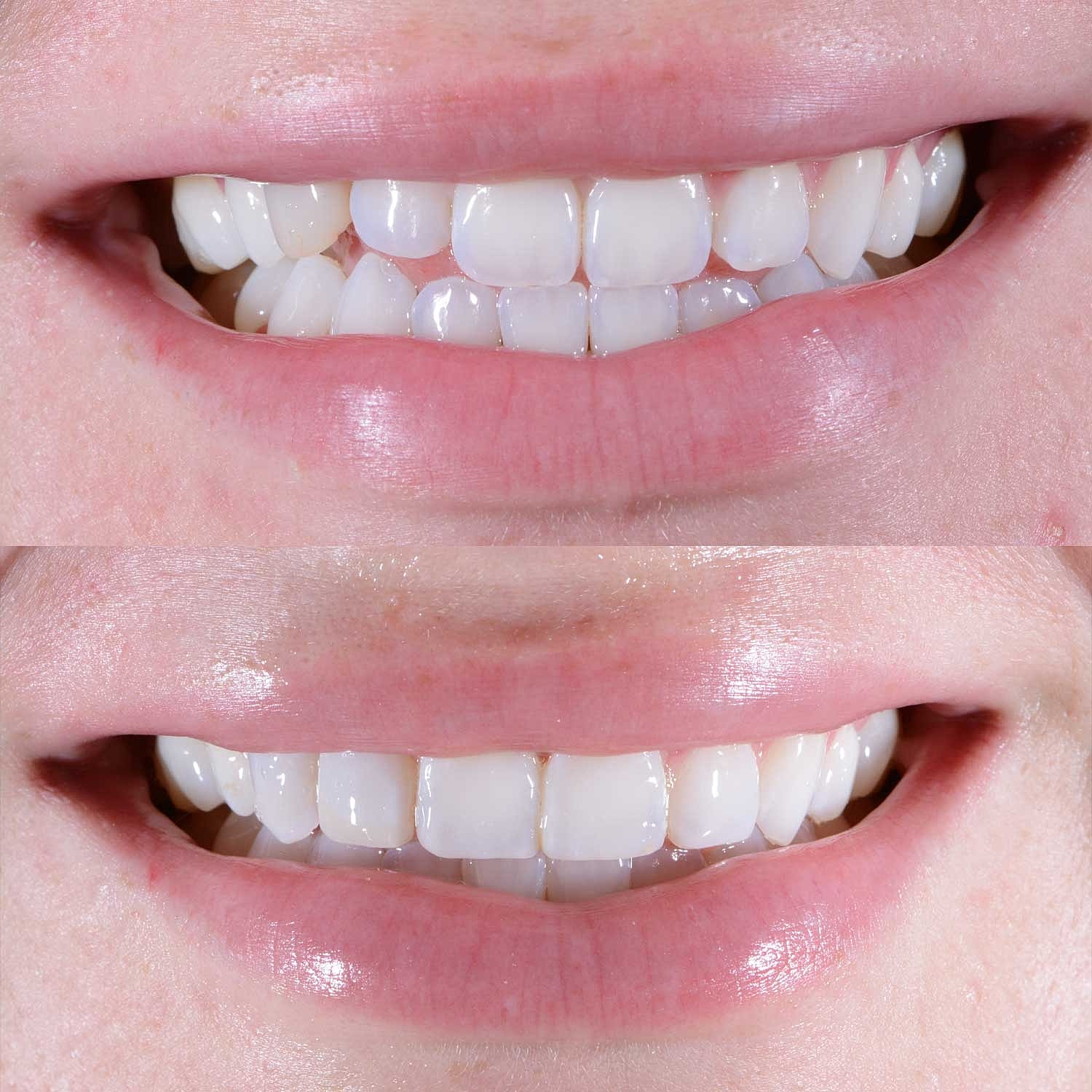 Porcelain Crown Veneers Before & After