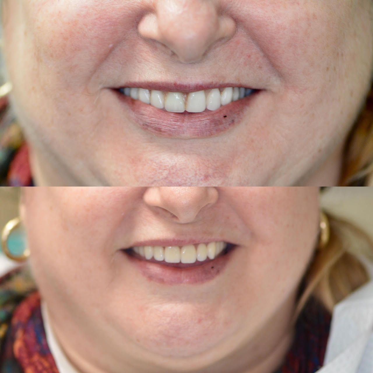 Geneva Dentures Before & After
