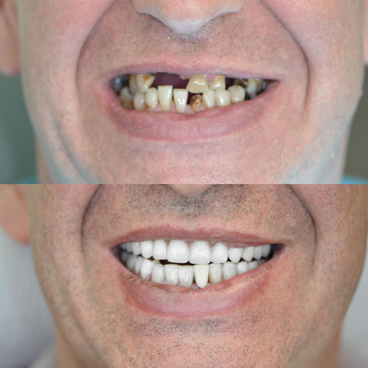 Geneva Dentures Before & After