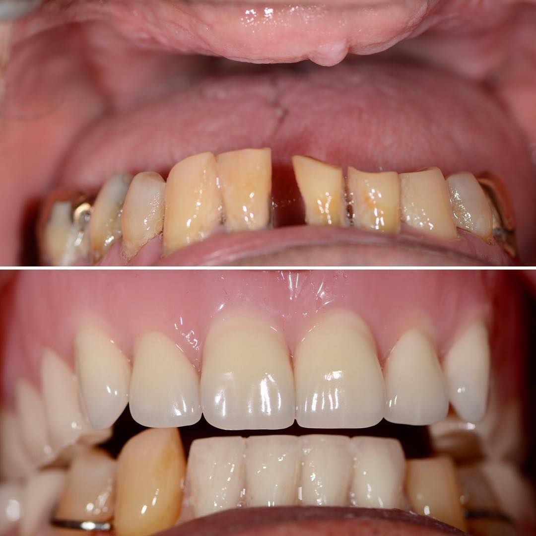 Geneva Dentures Before & After