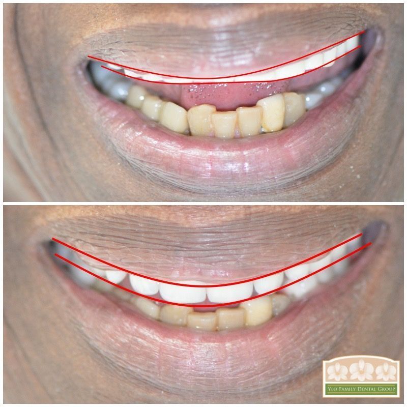 Geneva Dentures Before & After