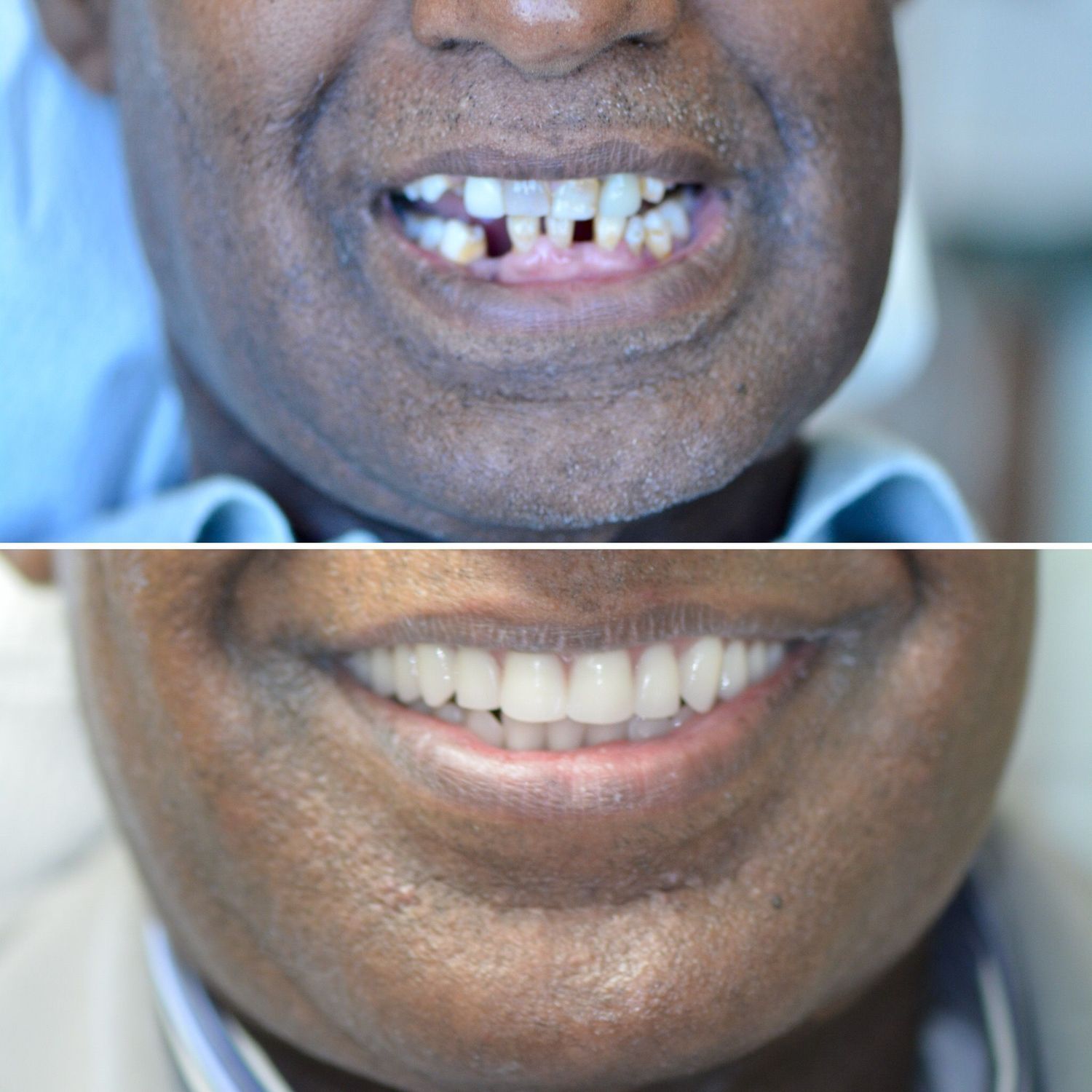 Implant Supported Dentures And Bridges Before & After