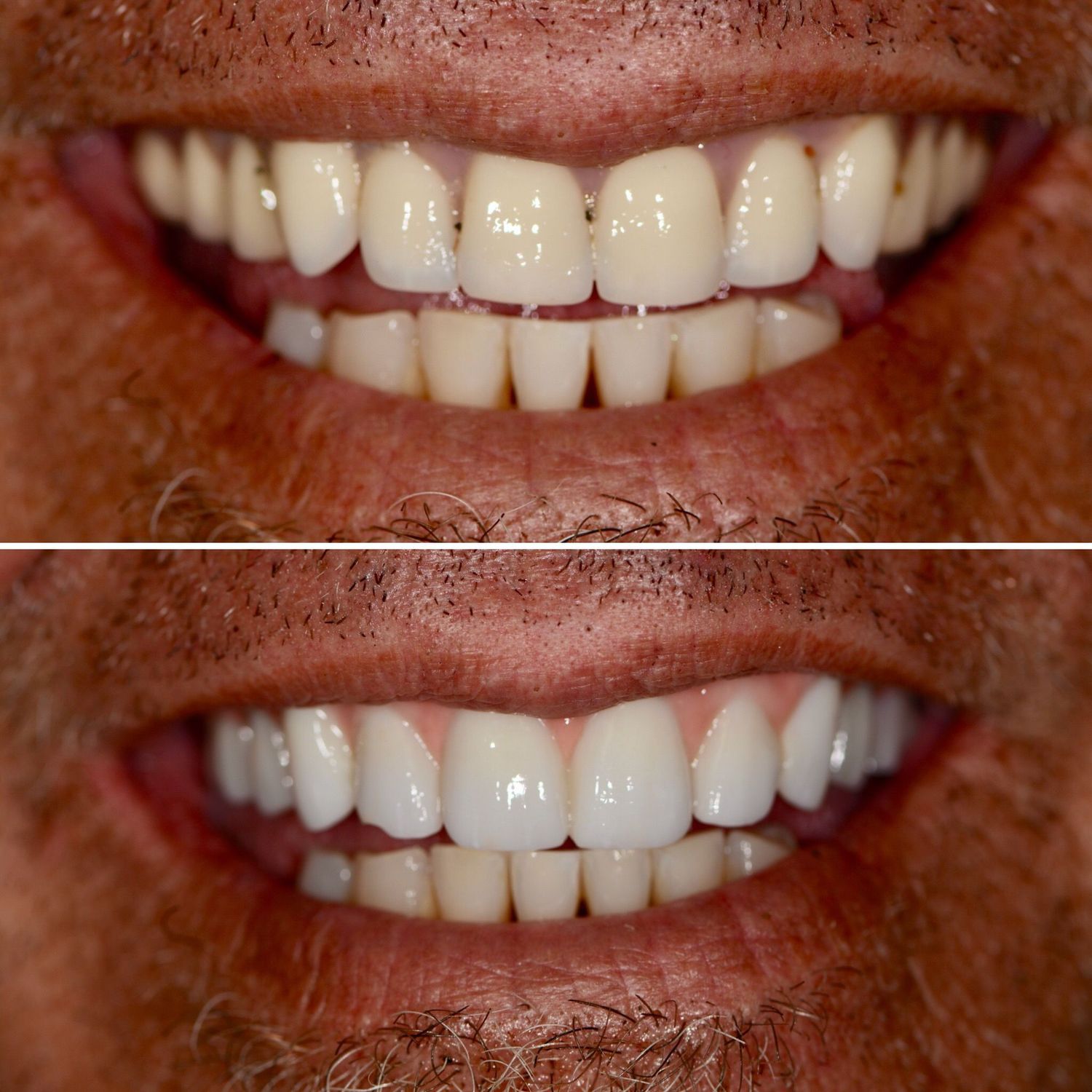 Implant Supported Dentures And Bridges Before & After