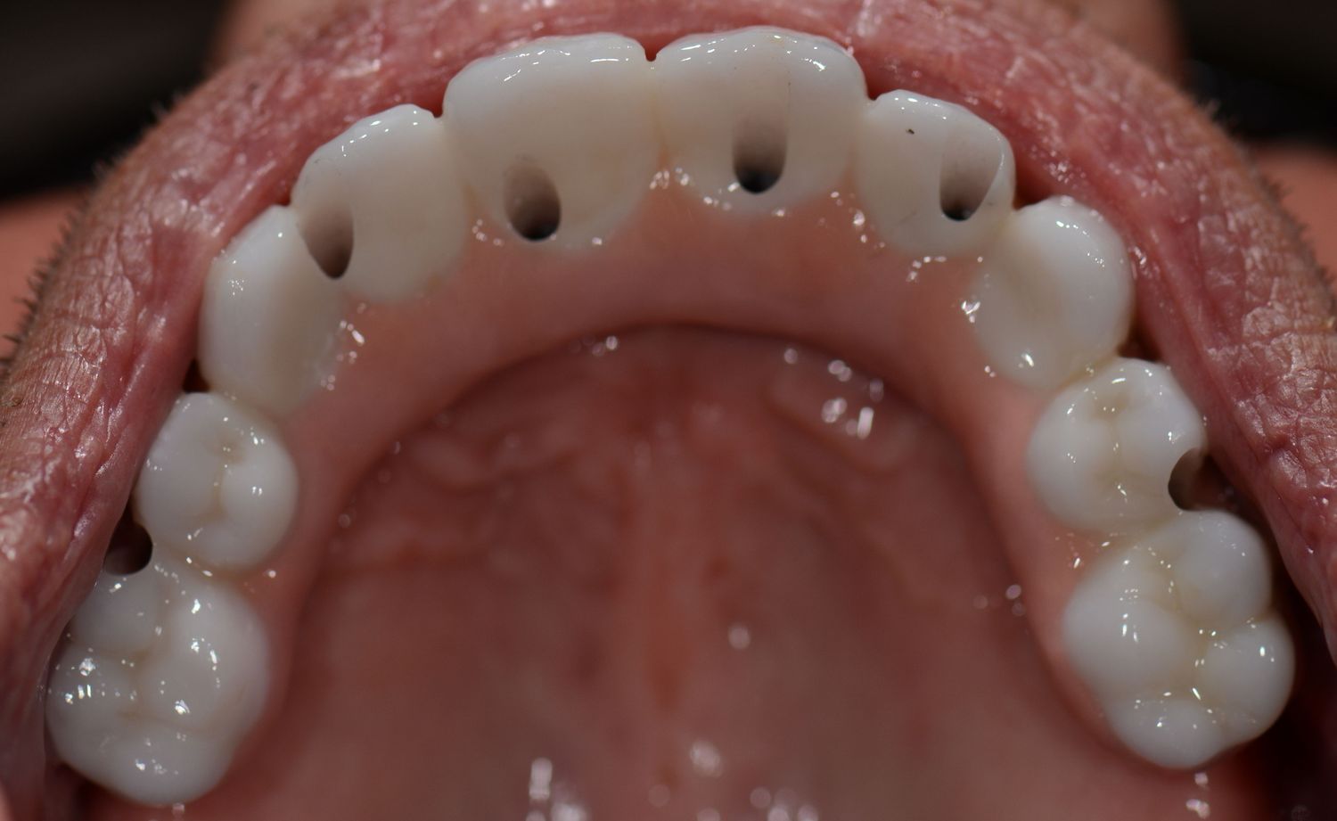 Implant Supported Dentures And Bridges Before & After